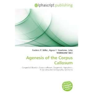  Agenesis of the Corpus Callosum (9786134077651) Books